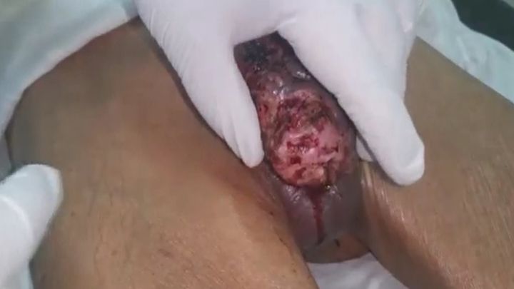 Половой орган мужчины съедают опарыши Половой орган мужчины съедают опарыши