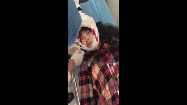 Девушке сорвало скальп Девушке сорвало скальп