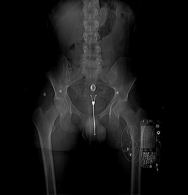 Когда пациент забыл снять штаны крючки, предметы в прямой кишке, рентген