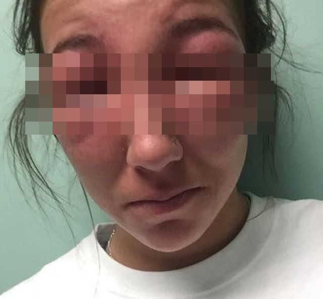 Девушке в глаза попал ядовитый плющ Девушке в глаза попал ядовитый плющ Ядовитый плющ, глаза