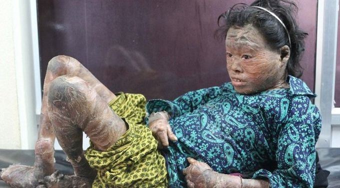 Девушка с кожными заболеванием выживает за счет обычного вазелина Девушка с кожными заболеванием выживает за счет обычного вазелина