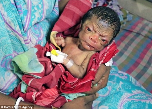 В Бангладеш родился малыш, который выглядит как старик генетическая мутация, прогерия, редкие болезни