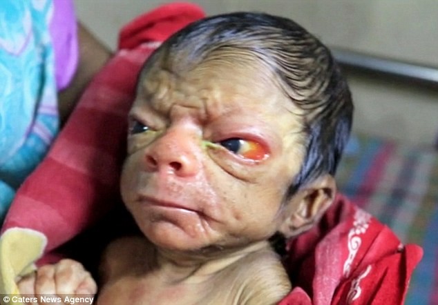 В Бангладеш родился малыш, который выглядит как старик генетическая мутация, прогерия, редкие болезни