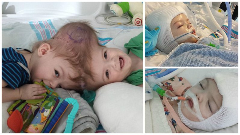 В США успешно прошла операция по разделению близнецов-краниопагов дети, операция, сша