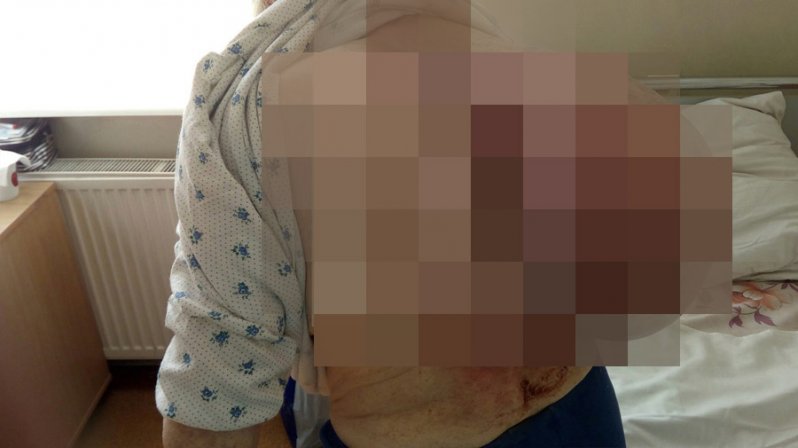Врачи вырезали у пенсионерки 10-килограммовую опухоль Врачи вырезали у пенсионерки 10-килограммовую опухоль