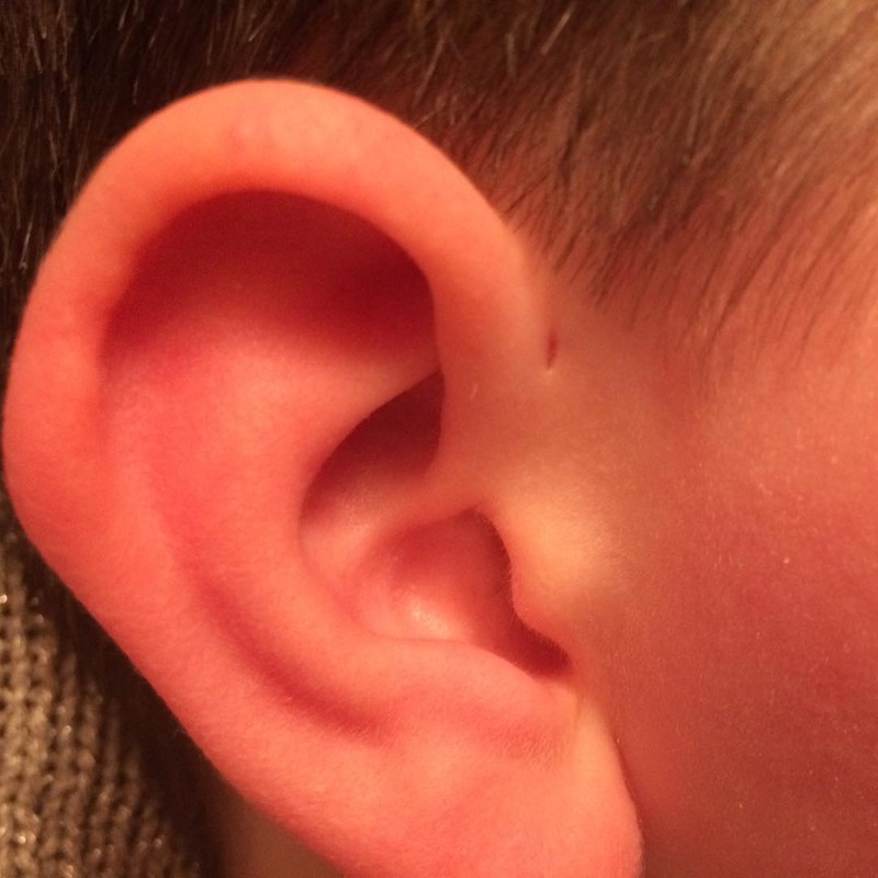 Вот почему некоторые люди рождаются с крошечным отверстием возле ушей люди, отверстие, ухо