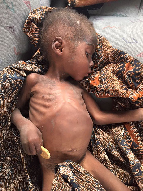 Как стал выглядеть спасенный мальчик, едва не умерший от недоедания  африка, дети, добро