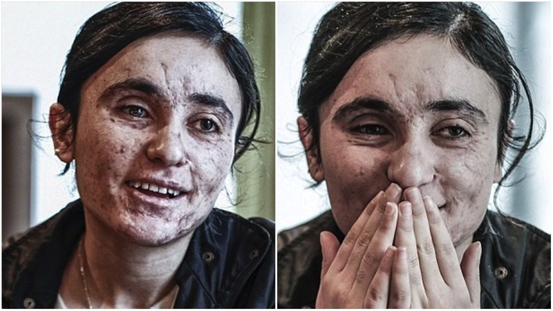 Несломленная: она два года была рабыней джихадистов, а убегая от них, наступила на мину