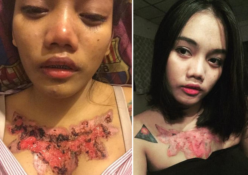 Самостоятельная попытка удалить татуировку изуродовала студентку студентка, татуировка