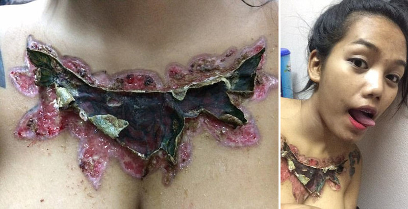 Самостоятельная попытка удалить татуировку изуродовала студентку студентка, татуировка