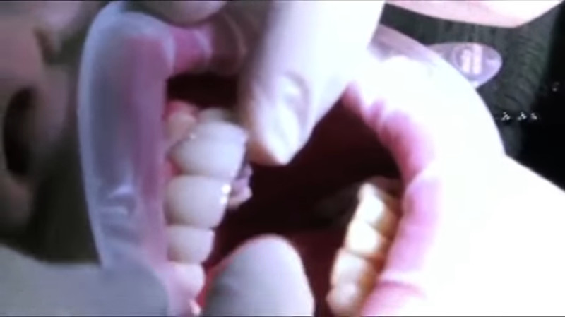 Через два месяца лечения и мучений Джей наконец приходит к дантисту, чтобы тот поставил ему на титановую основу новые зубы гигиена полости рта, дантист, зубной врач, зубной имплант, зубы, имплантация зубов, импланты, шок