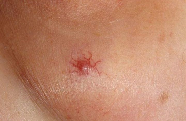 На лице красные точки: возможные причины и способы лечения