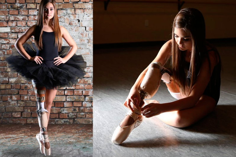 Даже с ампутированной ногой она исполнила свою мечту и стала… балериной! балерина, в мире, люди, мечта, ноги, сила воли, танцы