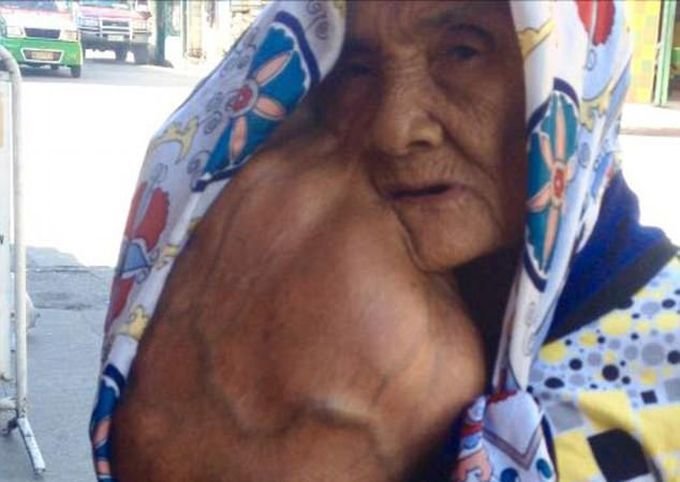 У пожилой женщины, после удаления родинки, на лице выросла огромная опухоль У пожилой женщины, после удаления родинки, на лице выросла огромная опухоль