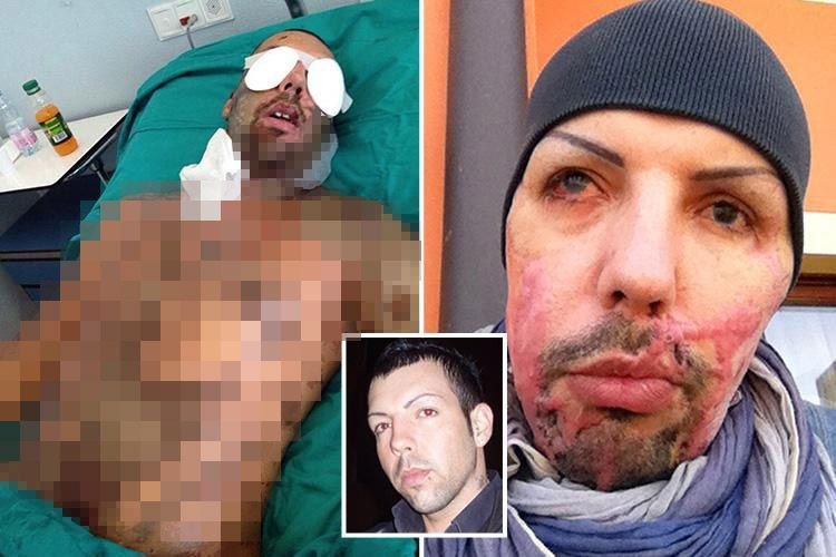 Девушка облила бывшего парня соляной кислотой Девушка облила бывшего парня соляной кислотой