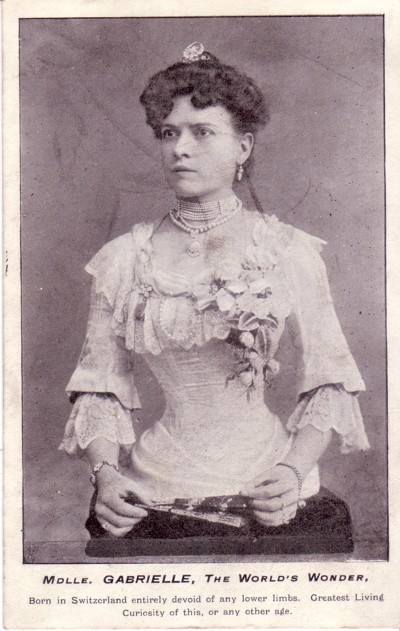 Люди-"половинки" и завидная воля к жизни