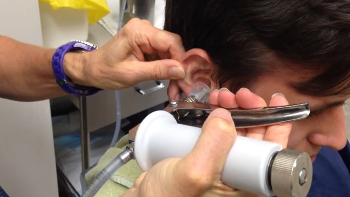 Извлечение огромного куска ушной серы из уха 