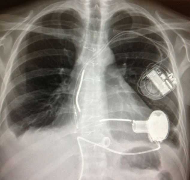 Во время медового месяца британец умер шесть раз