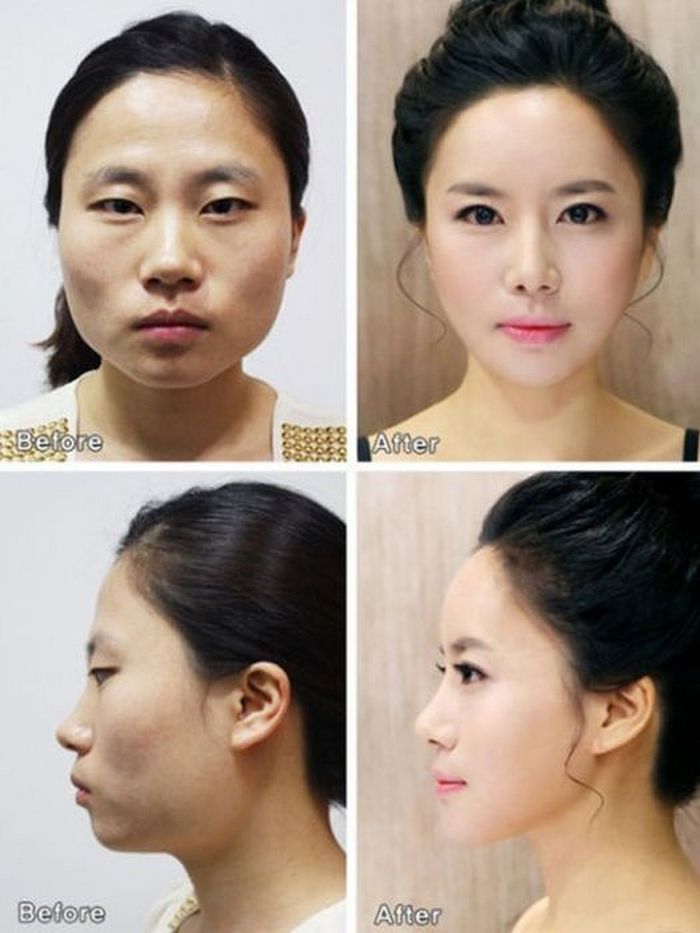 Фото до и после операции в корее до и после