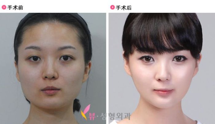 Пластическая операция в южной корее до и после