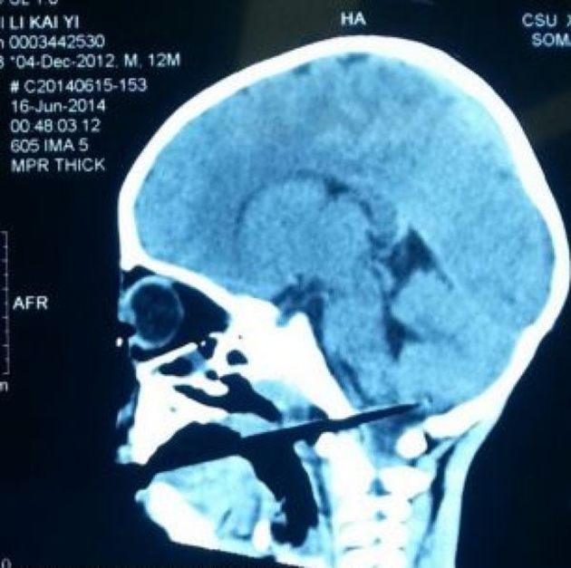 Мальчик воткнул палочку для еды себе в горло