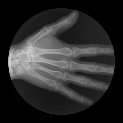 Рентген руки, сжимающейся в кулак