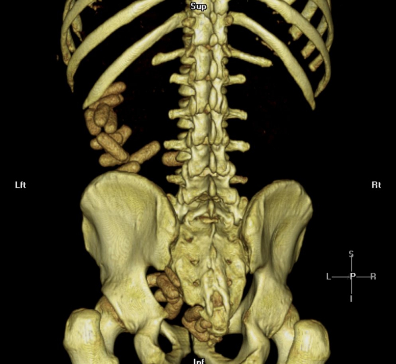 Удивительные рентгенограммы: инородные предметы в человеческом теле