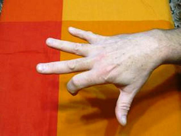 Как восстановить палец после. Реабилитация руки после инсульта.