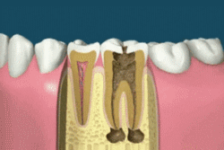Пломбирование каналов зуба