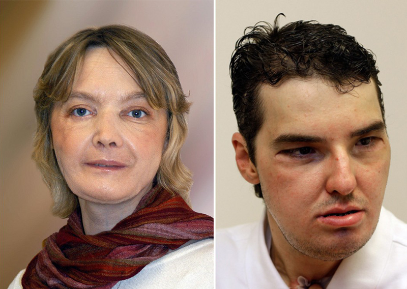 Донорство лица. Изабель Динуар до и после операции. Люди с пересаженной кожей.