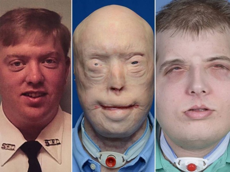 США: пациент показал новое лицо спустя год после пересадки