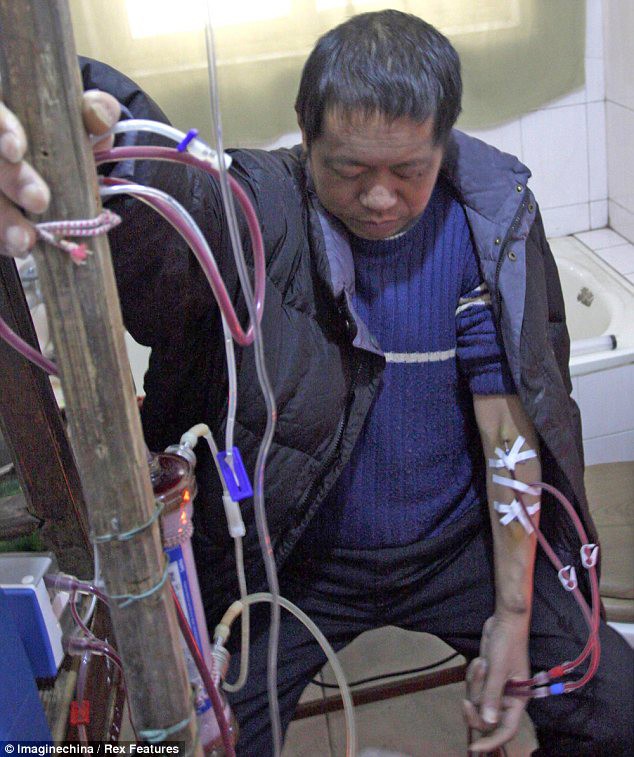 Не имея денег, китаец создал себе машину для диализа, которая помогает ему уже 13 лет