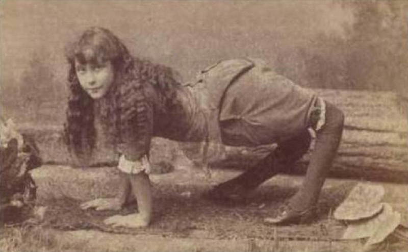 Элла Харпер — известная под именем «девочка-верблюд». Родилась с очень редким генетическим отклонением, её коленки были выгнуты в обратную сторону.