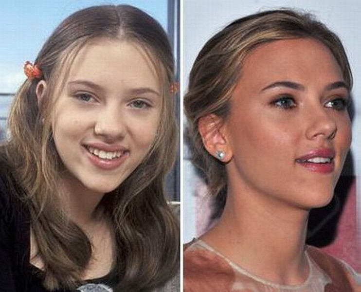 Пластика до и после фото знаменитостей