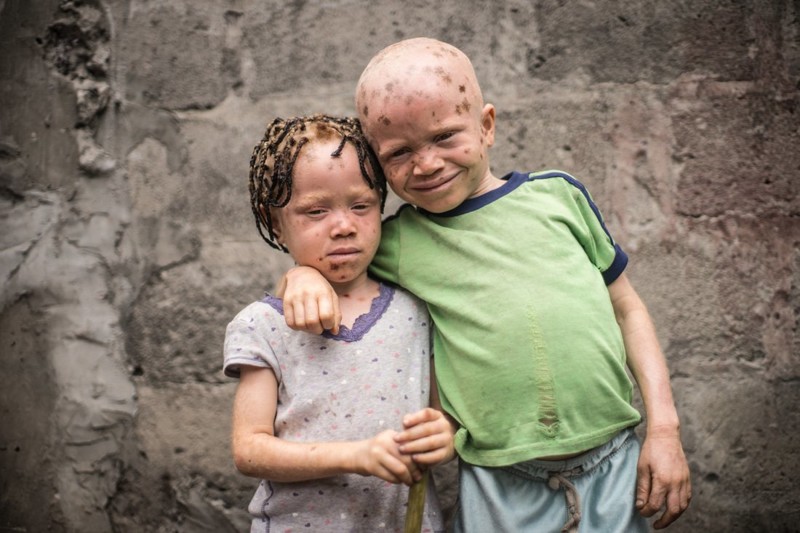 Невероятно: люди-альбиносы в Конго!
