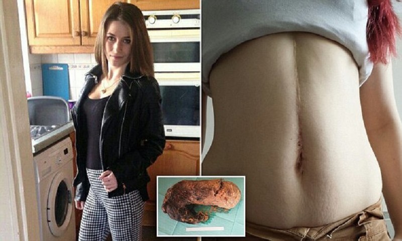 Хирурги удалили из желудка девушки 1,5-килограммовый ком волос
