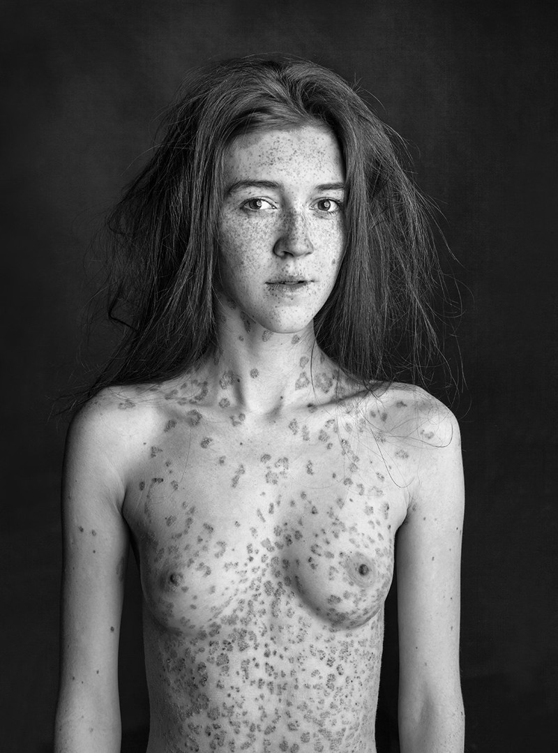 псориаз на груди у женщин фото 98