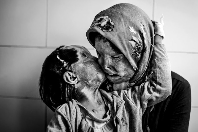 3-летняя Рана целует свою 29-летнюю мать Сомайе Мери. По их словам, после того как им в лицо плеснули кислотой, другие люди не горят желанием целовать их.
