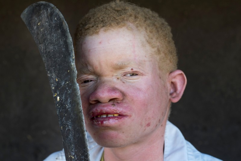 Альбинизм у людей — Википедия