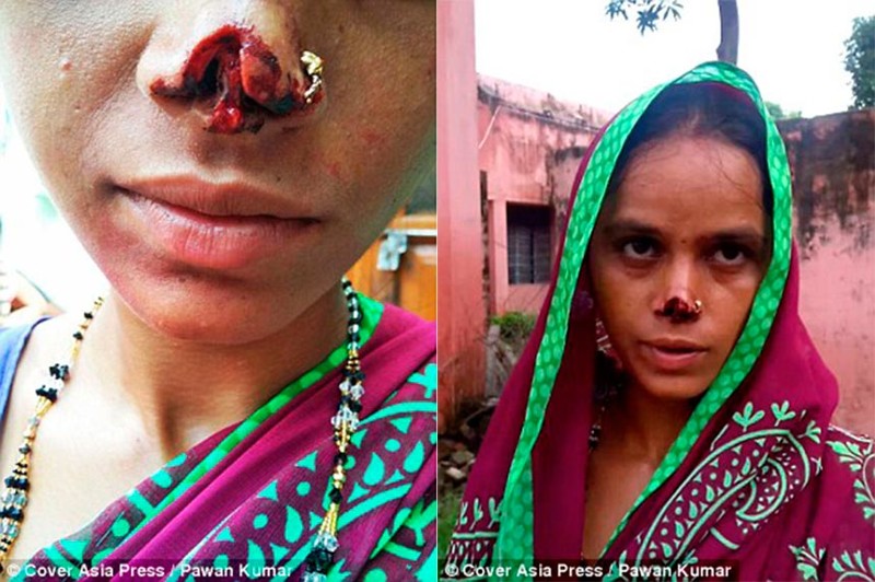 Обидевшись из-за приданного, индиец отрезал жене нос и сбежал с ним