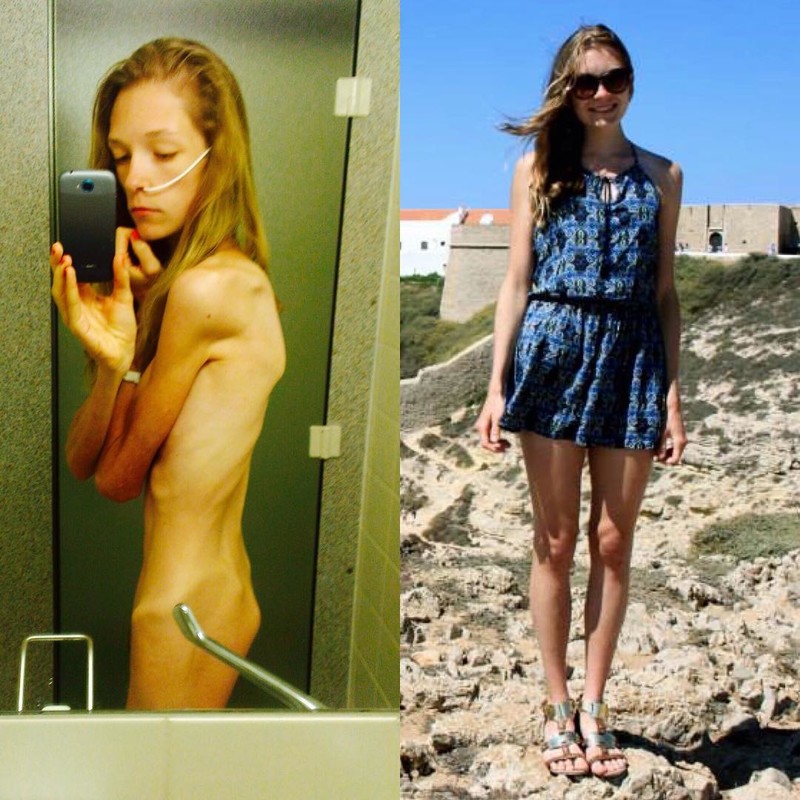 "Не нужно стыдливо закрывать глаза на правду": бывшая анорексичка показывает, что это такое - весить 30 кг