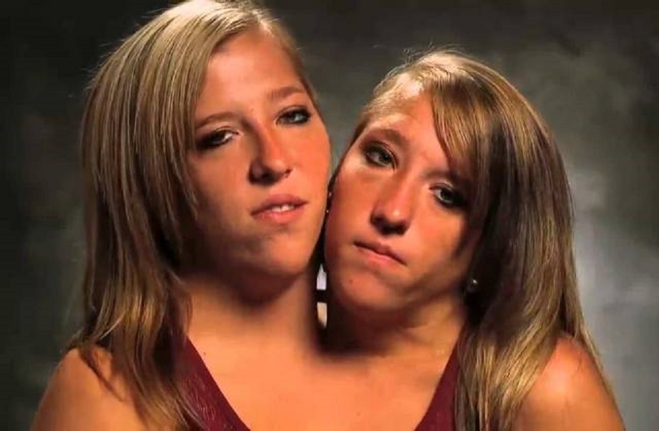 15 интересных фактов о сиамских близняшках Хенсел 