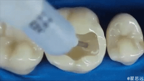 Процесс пломбирования зуба