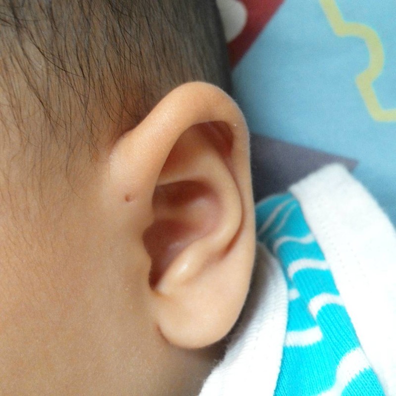 Вот почему некоторые люди рождаются с крошечным отверстием возле ушей