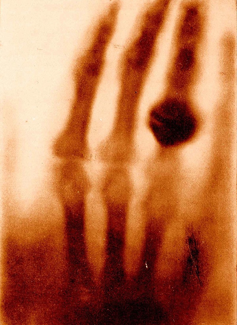 Первый в мире рентгеновский снимок. Рука Анны Берты Рентген снята ее мужем, Вильгельмом, в 1895 году.  