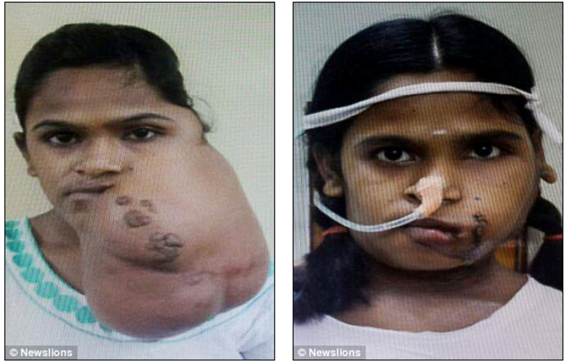 Индийская девочка улыбнулась впервые за 14 лет после того, как хирурги удалили опухоль с ее лица