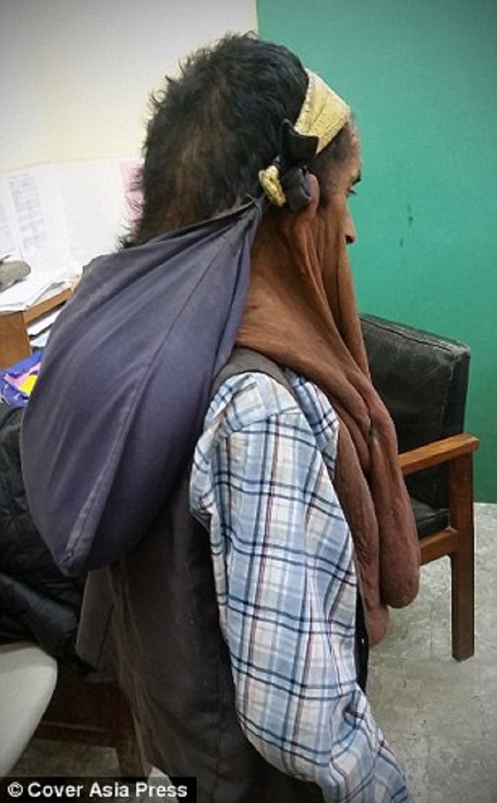 Непальцу удалили огромную опухоль на лице, с которой он прожил 47 лет