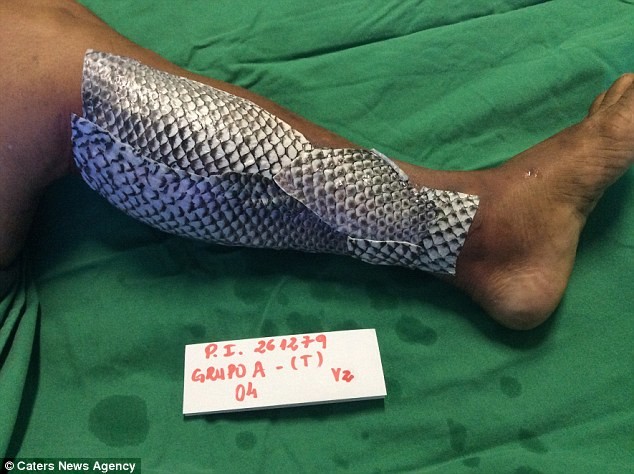Впервые для лечения ожогов применили рыбью кожу