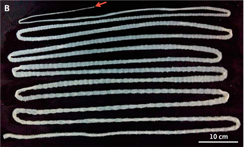 21. В Китае врачи вытащили этого 6-метрового ленточного червя из парня, который любил полакомиться сырой говядиной