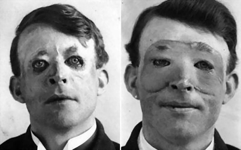 Вальтер Ио – один из первых, кто прошел пластическую операцию и пересадку кожи, 1917 год.
